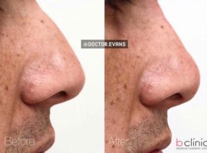 Dermal filler nose treatment treatment by Dr Mitch