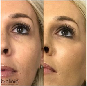 Dermal filler tear trough and cheek treatment by Dr Lee