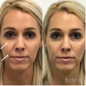 Dermal filler tear trough & nasolabial fold treatment by Dr Lee