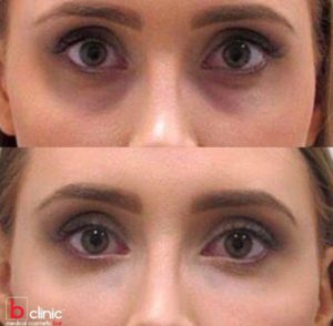 Dermal filler tear trough treatment