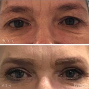 Blepharoplasty eyelid surgery by Dr Lee