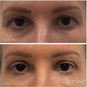 Blepharoplasty eyelid surgery by Dr Lee