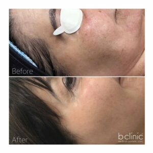 Fractional laser skin resurfacing post 1 treatment by Selina