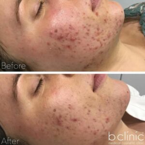 Jessner skin peel post 1 treatment