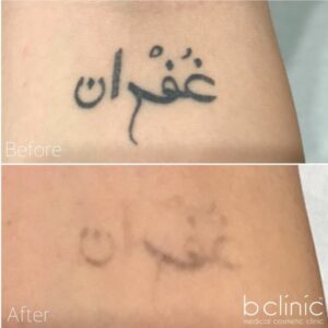 Laser Tattoo Removal post 5 treatments with Jess