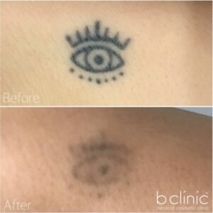 Laser Tattoo Removal post 5 treatments with Jess