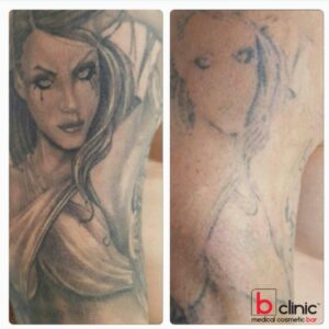 Laser tattoo removal by Jess