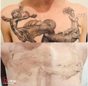 Laser tattoo removal post 1 treatment