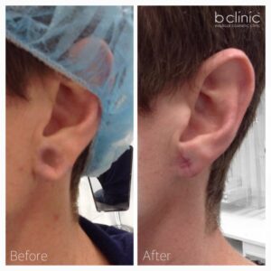 Lobuloplasty earlobe surgery by Dr Lee