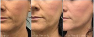 Mid face dermal filler & Matrix PDO thread by Dr Lee & Marian RN