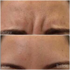 Muscle relaxant frown lines treatment Dr Frank
