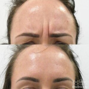 Muscle relaxant frown lines treatment by Dr Elle