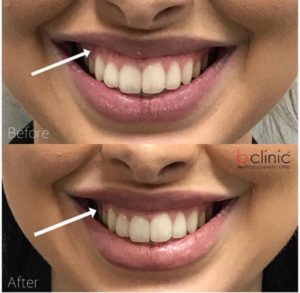 Muscle relaxant gummy smile treatment by Dr Lee