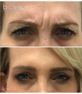 Muscle relaxant brow lift treatment by Dr Lee