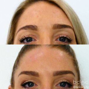 Muscle relaxant brow lift treatment by Dr Elle