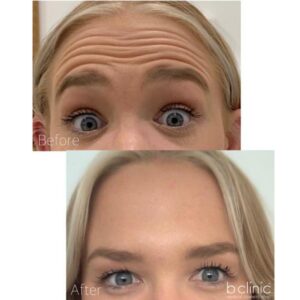 Muscle relaxant forehead treatment by Dr Lee