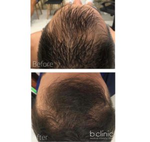 PRP hair restoration by Dr Frank