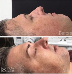 Picosure laser post 1 pigmentation treatment