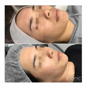 Picosure laser post 2 pigmentation treatments by Chris