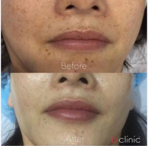 Picosure laser post 2 skin rejuvenation/pigmentation treatments