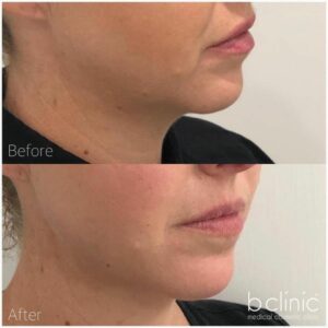 Thread lift lower face treatment by Dr Lee