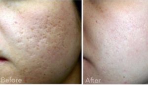 eTwo sublative post 3 acne scarring treatments