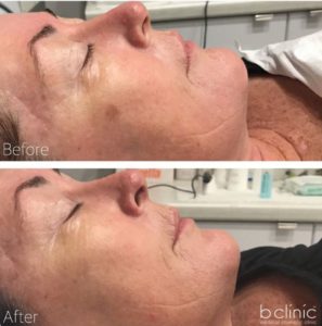 Skin needling pigmentation treatment