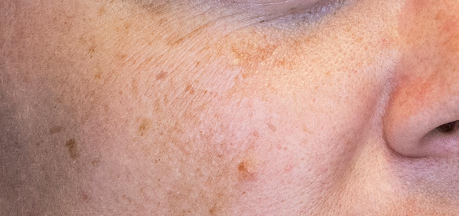 Pigmentation Removal With Laser