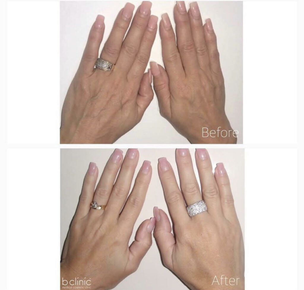 anti-ageing hands before and after